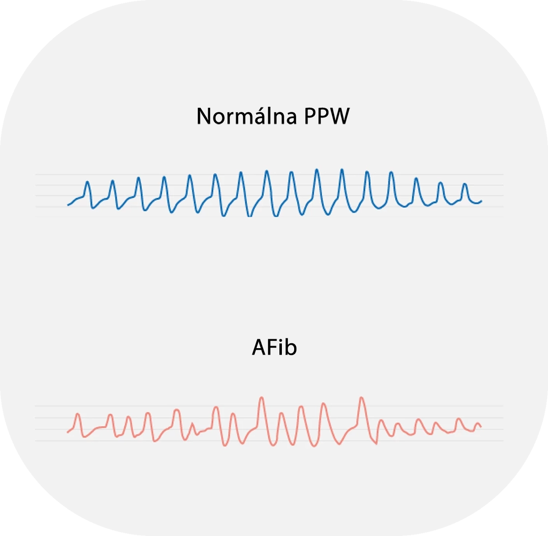 Krivka AFib